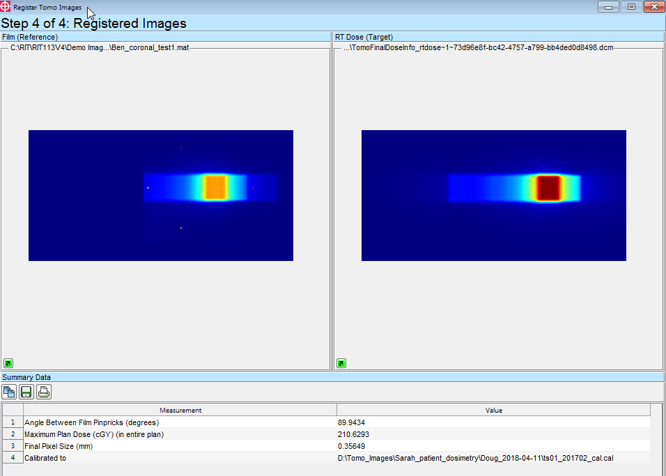TomoTherapy Registration